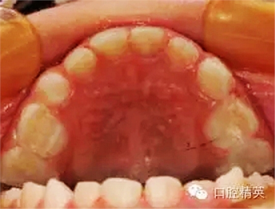 全麻下儿科治疗+儿牙树脂充填