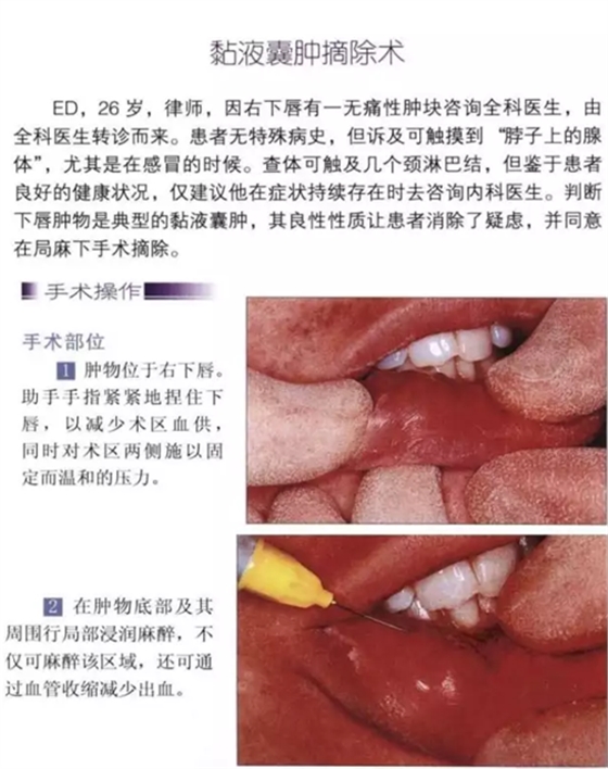 粘液腺囊肿切除术