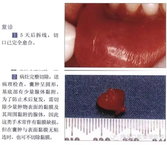 粘液腺囊肿切除术