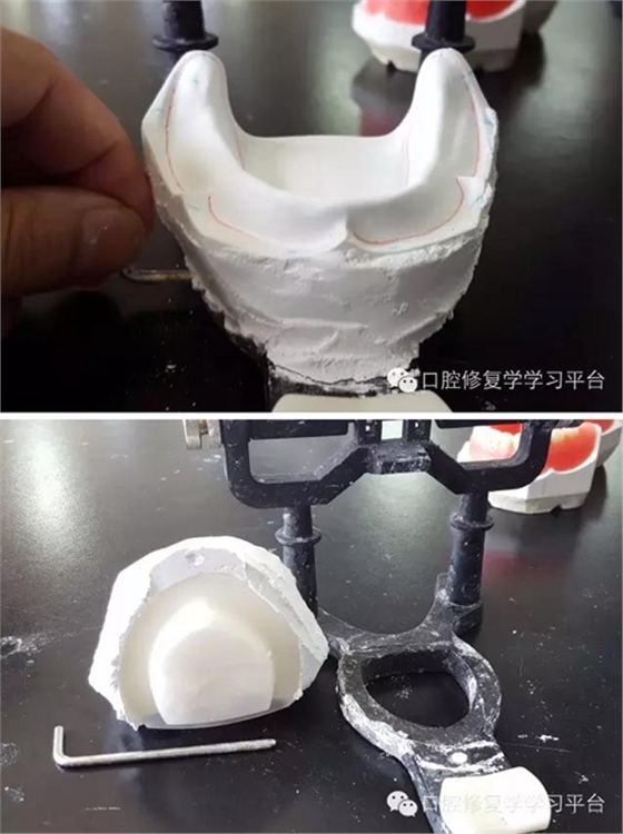 全口义齿的制作:排牙方法 科贸嘉友收录