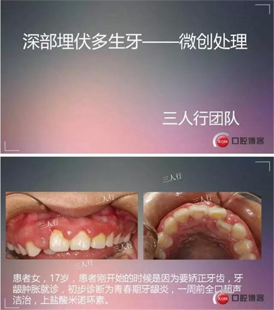 深部埋伏多生牙——微创处理  
