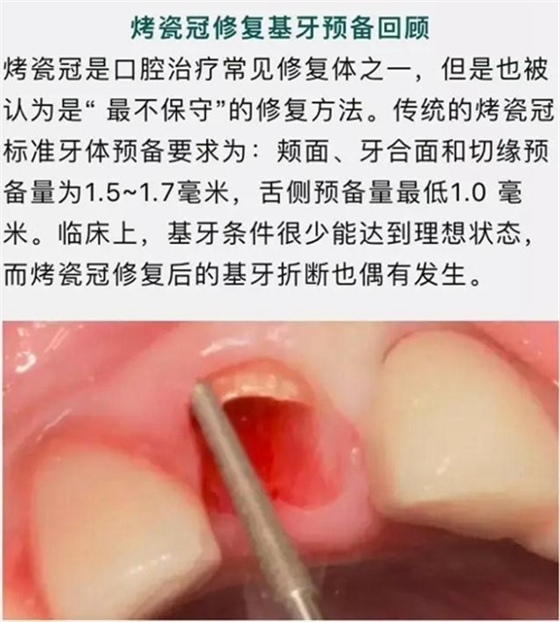 做全冠修复时基牙根面暴露，如何备牙？