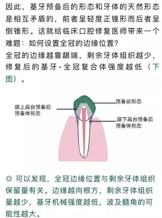 做全冠修复时基牙根面暴露，如何备牙？
