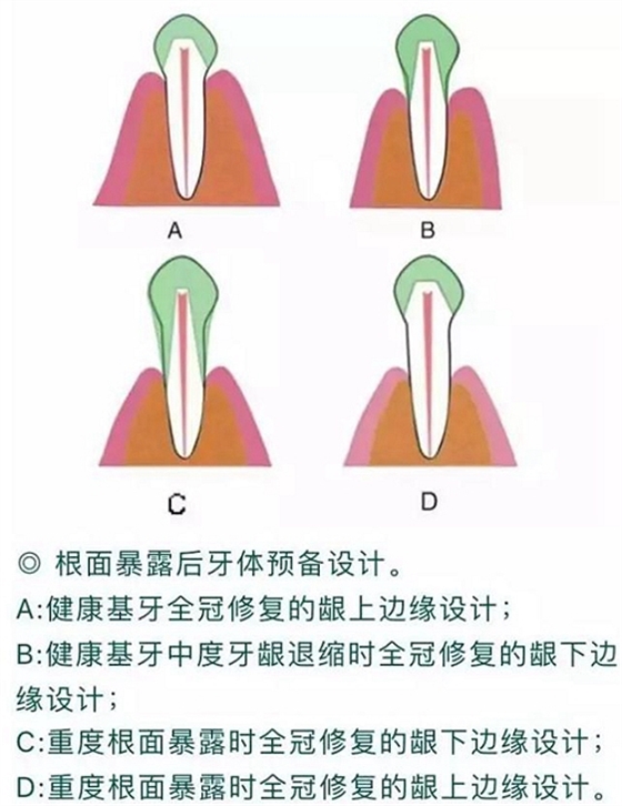 做全冠修复时基牙根面暴露，如何备牙？