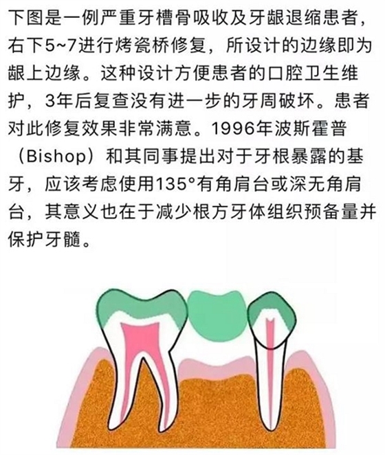做全冠修复时基牙根面暴露，如何备牙？