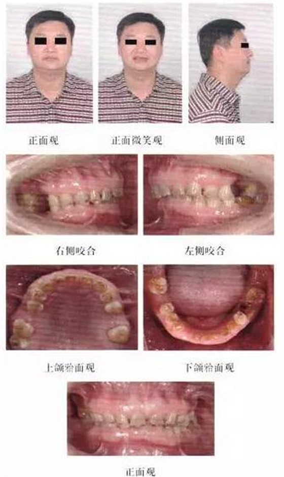 正畸修复联合咬合重建1例 