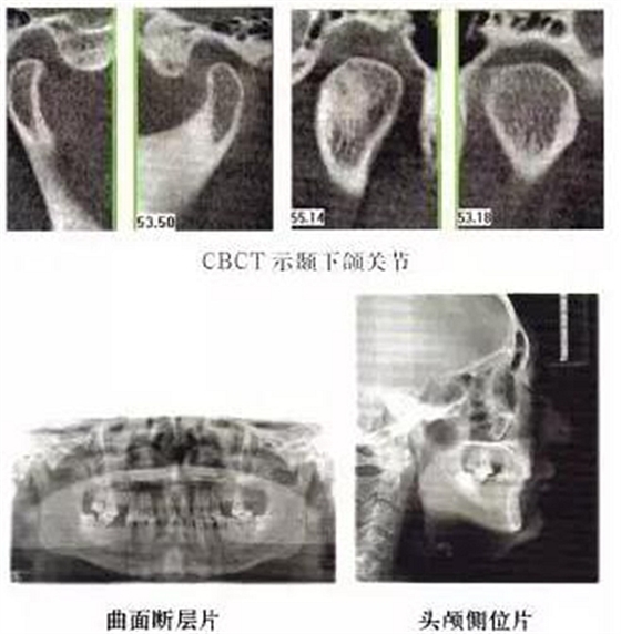 正畸修复联合咬合重建1例 