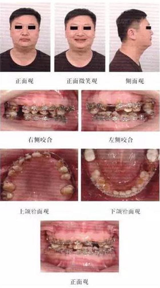 正畸修复联合咬合重建1例 