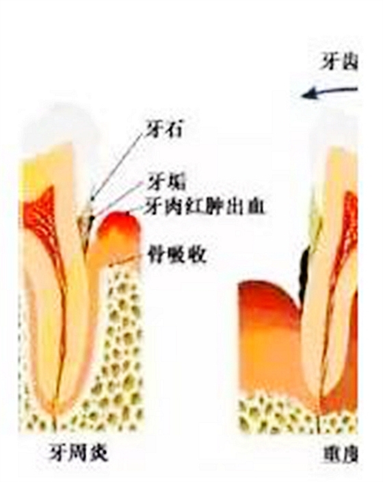 根管治疗图谱