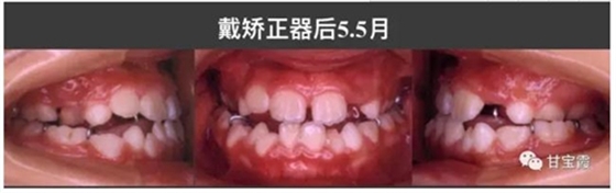 口腔不良习惯会引起牙颌畸形
