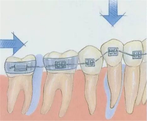 正畸矫正牙齿的基本原理图示