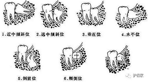 智齿一定要拔吗?