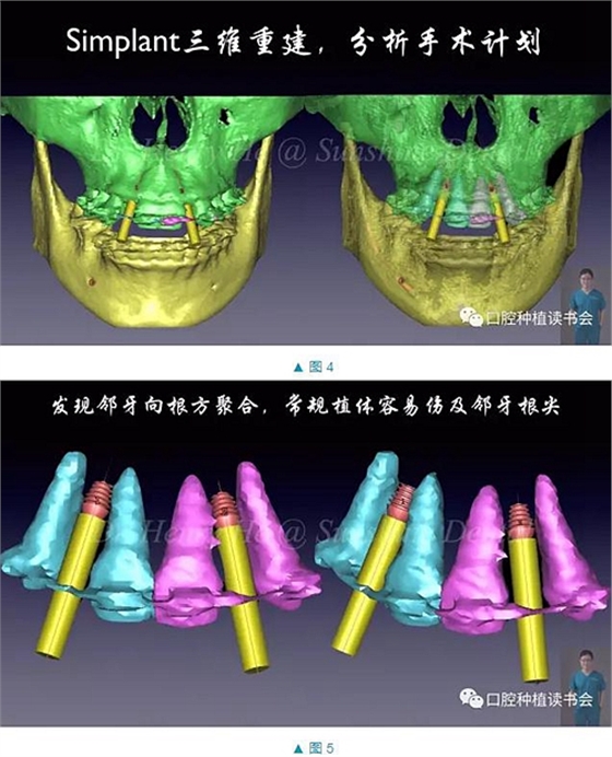 短种植体在前牙美学区应用的临床病例报道（上）