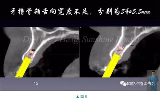 短种植体在前牙美学区应用的临床病例报道（上）