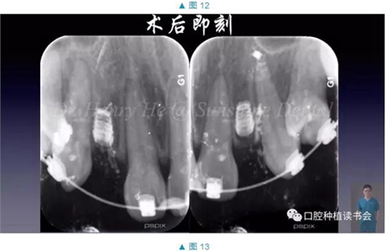 短种植体在前牙美学区应用的临床病例报道（上）