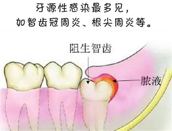 警惕！牙疼引发的间隙感染很危险