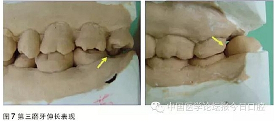 凸凹式后牙咬合接触及其临床意义——王美青教授