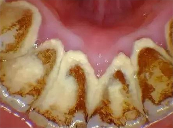 等其它口腔清洁措施不能去除的牙菌斑,牙结石以及牙齿表面的一些着色