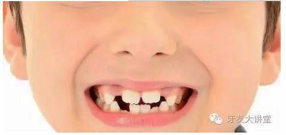 12岁前必须处理的20种儿童牙颌畸形【口腔科普】
