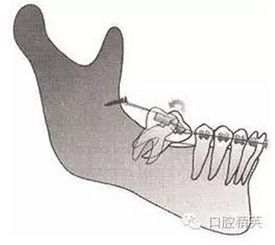 种植体支抗原理及分类 科贸嘉友收录