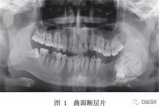 下颌骨骨化纤维瘤并发组合性牙瘤1例