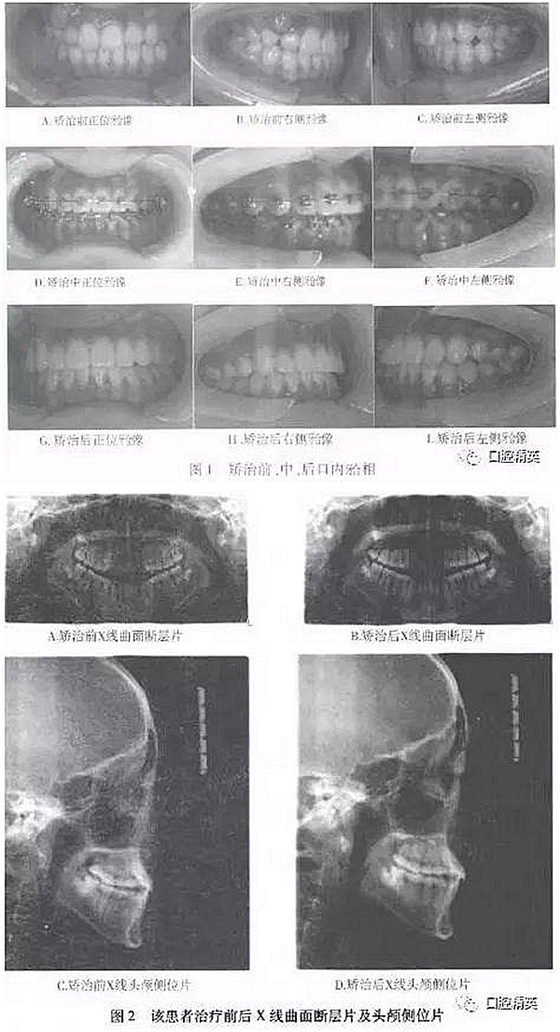 尖牙完全唇侧错位拥挤，矫正1例  