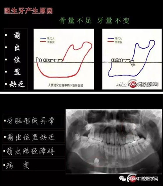 智齿拔除