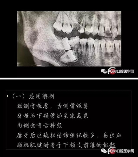 智齿拔除