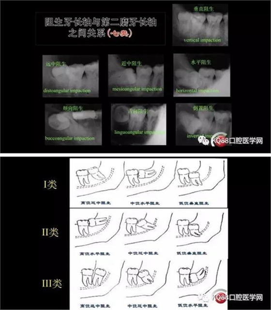 智齿拔除