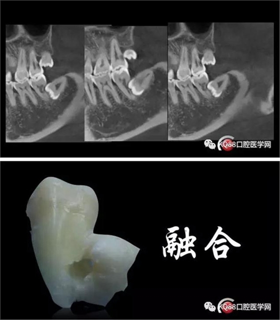 智齿拔除