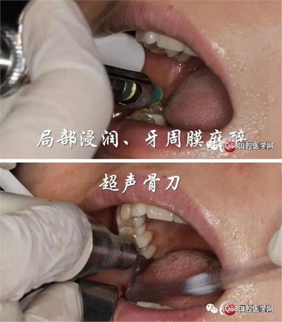 智齿拔除