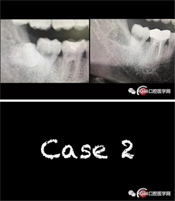 智齿拔除