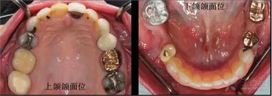 (3)上下颌颌面位 (occlusal view)(上颌牙弓,下颌牙弓各   张)