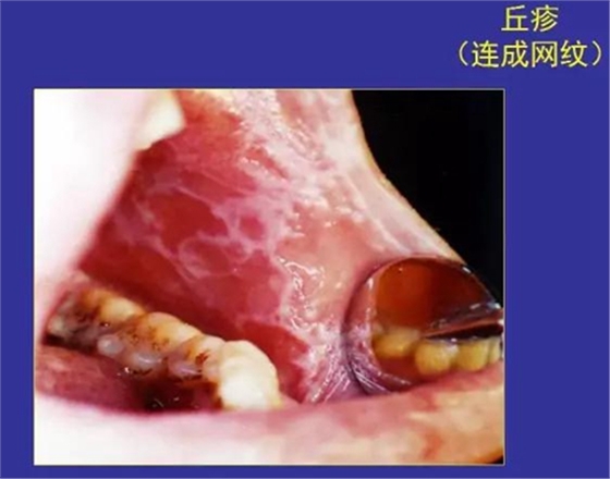 正常口腔黏膜及常见病损图