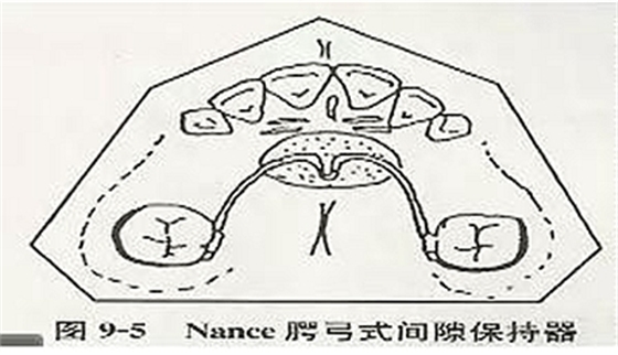 【牙医干货】各种间隙保持器赏析