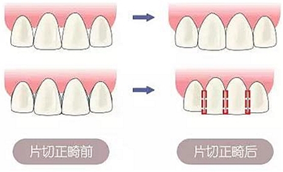 医生方案里的邻面去釉，究竟是什么？