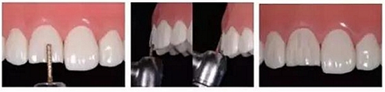 前牙全瓷冠牙体预备步骤   