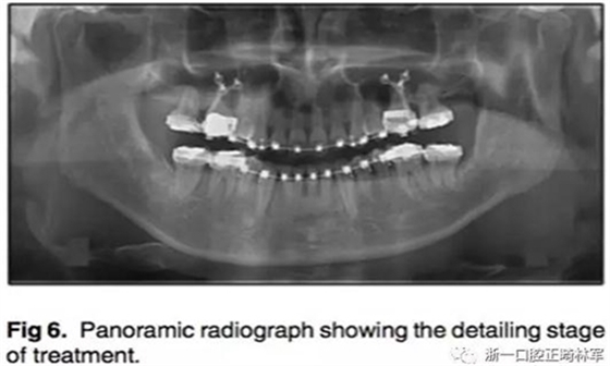 通入上颌窦上颌后牙区间隙的关闭探索