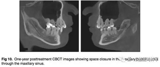 通入上颌窦上颌后牙区间隙的关闭探索
