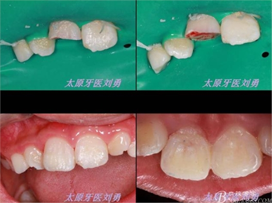 刘勇：断牙再粘结两例病例 