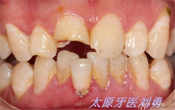 刘勇：断牙再粘结两例病例 