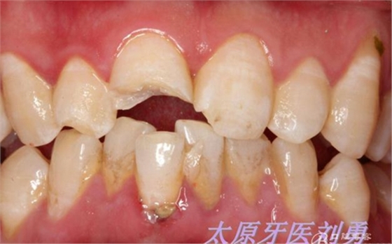 刘勇：断牙再粘结两例病例 