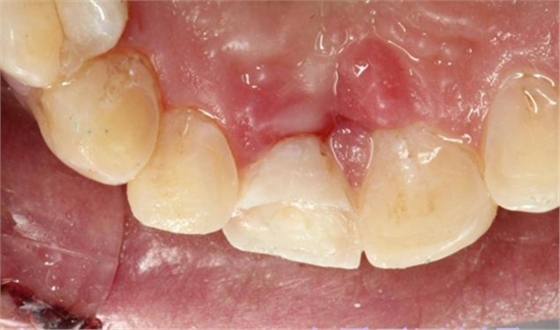 刘勇：断牙再粘结两例病例 