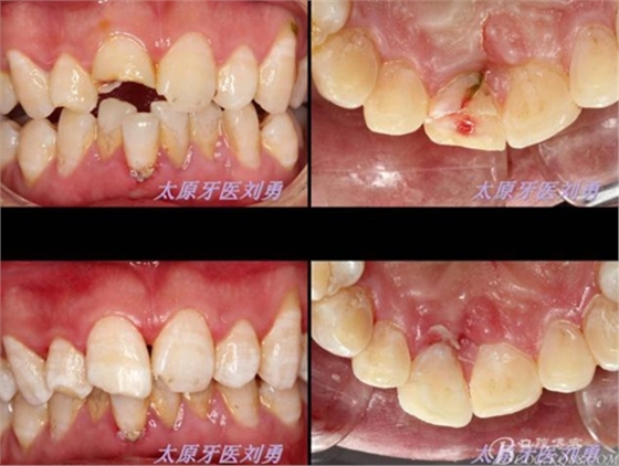 刘勇：断牙再粘结两例病例 