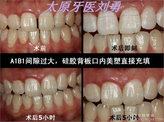 刘勇：断牙再粘结两例病例 