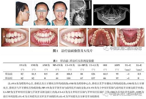 病例报告 | 上颌种植体支抗Ⅲ类牵引矫治骨性Ⅲ类反牙合伴开牙合1例报告