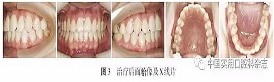 病例报告 | 上颌种植体支抗Ⅲ类牵引矫治骨性Ⅲ类反牙合伴开牙合1例报告