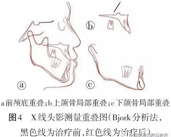 病例报告 | 上颌种植体支抗Ⅲ类牵引矫治骨性Ⅲ类反牙合伴开牙合1例报告