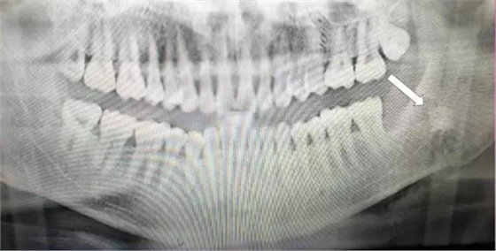 拔牙断根的去与留？