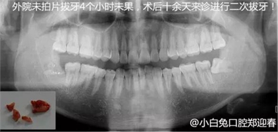 拔牙断根的去与留？